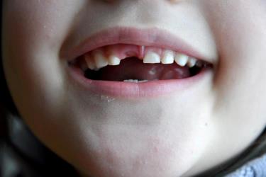 Barn med tabt tand